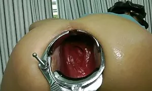 speculum prolapse s  ...